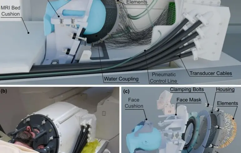 Ультразвуковий шолом для неінвазивного лікування неврологічних хвороб — винахід британських вчених — новини науки 1