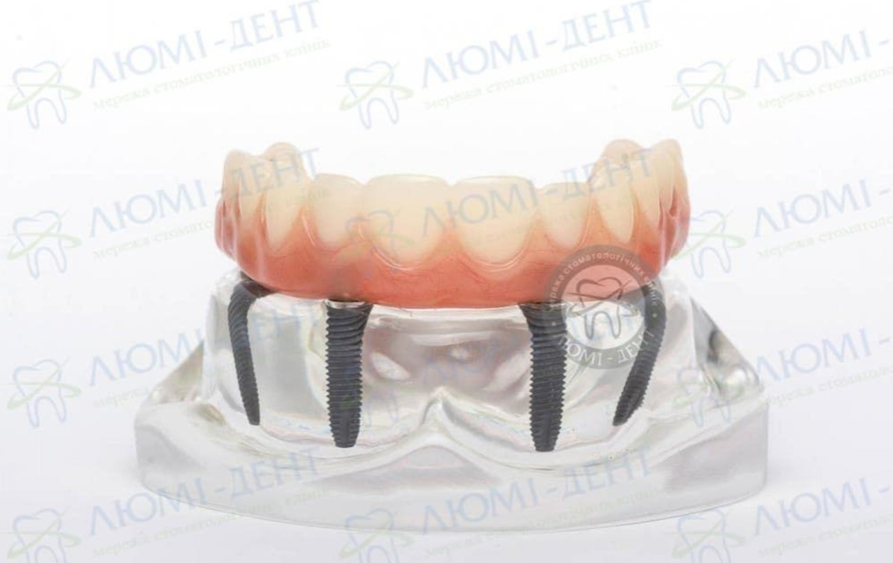 Імплантація зубів при захворюваннях ясен - що може стати на заваді 2