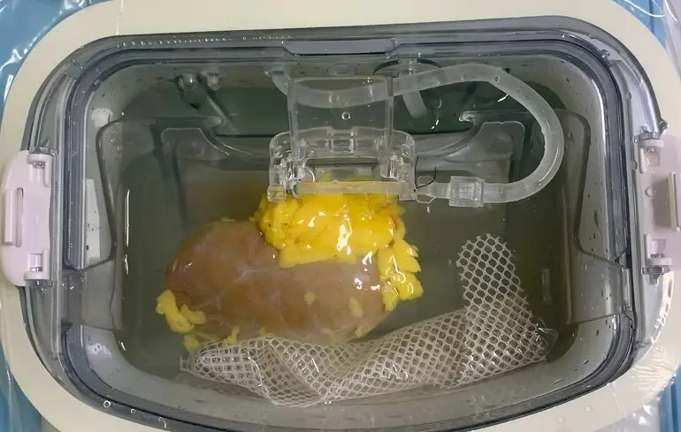 Універсальна нирка - вчені створили орган, який підходить людині з будь-якою групою крові 1