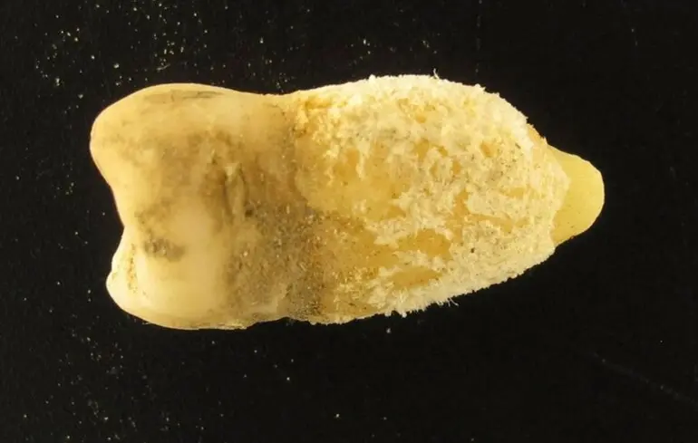 Вчені виявили бактерії, що викликають скарлатину, у зубі мумії, знайденої в Болівії. 1